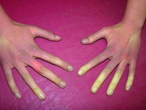 Minderdurchblutung an den Fingern Raynaud-Zeichen Raynaud-Zeichen Minderdurchblutung